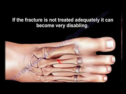 Video: Fracture Of The Metatarsal Bone Of The Foot