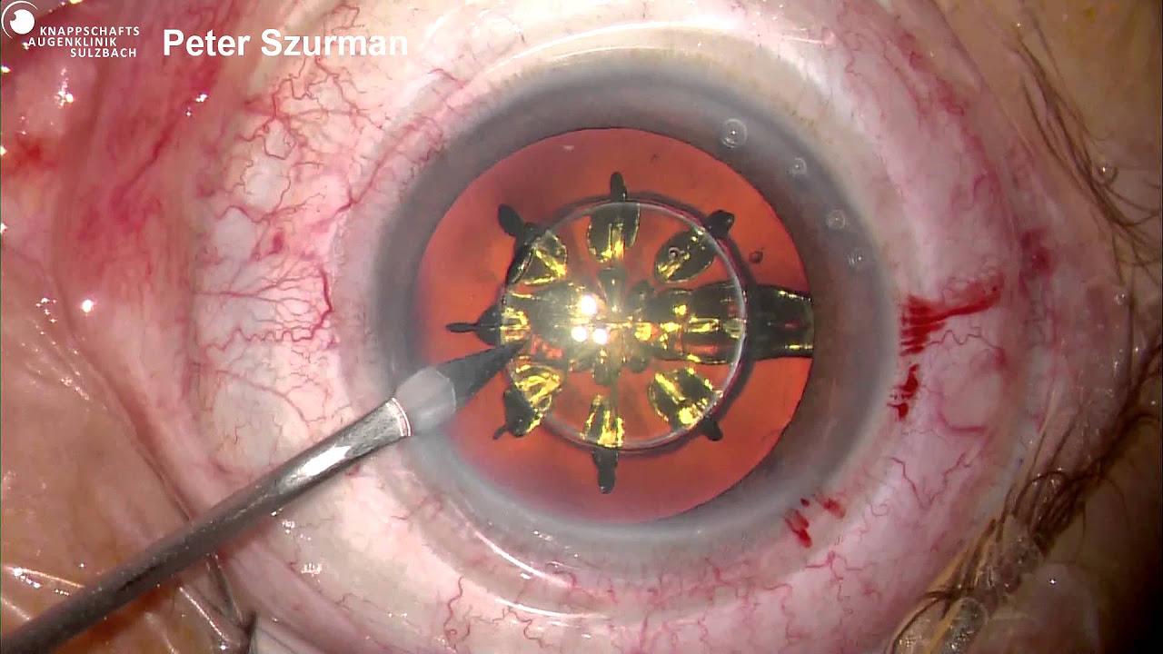 Implantation einer Multifokallinse ReSTOR zur Korrektur der Altersichtigkeit- Peter Szurman