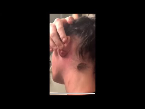 Rahatlatıcı Sivilce Sıkma Videoları Relaxing Pimple Tightening Videos 2021   Part 2