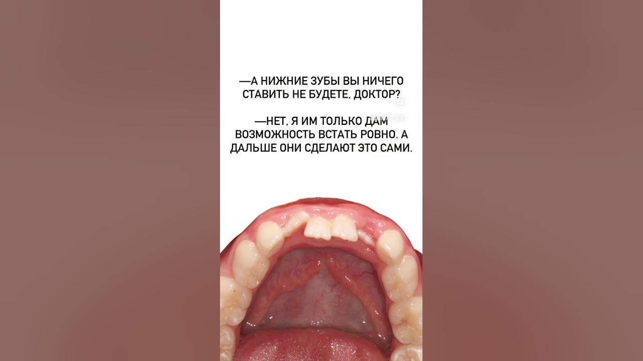 Кривые нижние зубы у детей - YouTube