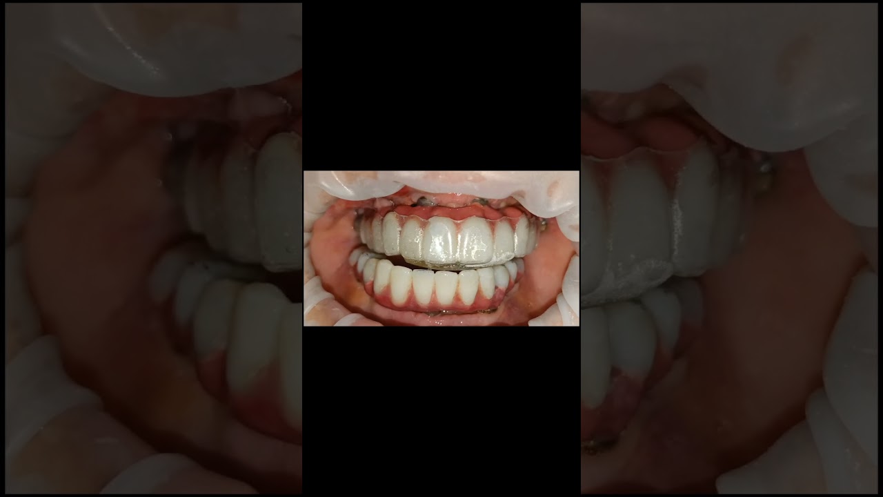 How much posterior disclusion to give+anterior deprogrammer for full mouth impalnt teeth replacement