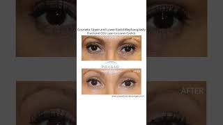 Real Results PRP + Laser Skin Treatments #wrinkles