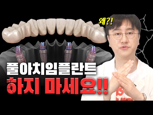 디지털 풀아치 임플란트가 사실.. OO임플란트의 대안책❓