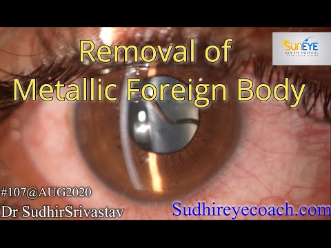 Video: Foreign Body In The Eye - Sensation, Entry, Removal