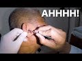 Removing  Elderly Man's Hardest Impacted Earwax with Massive Amount of Earwax Softener