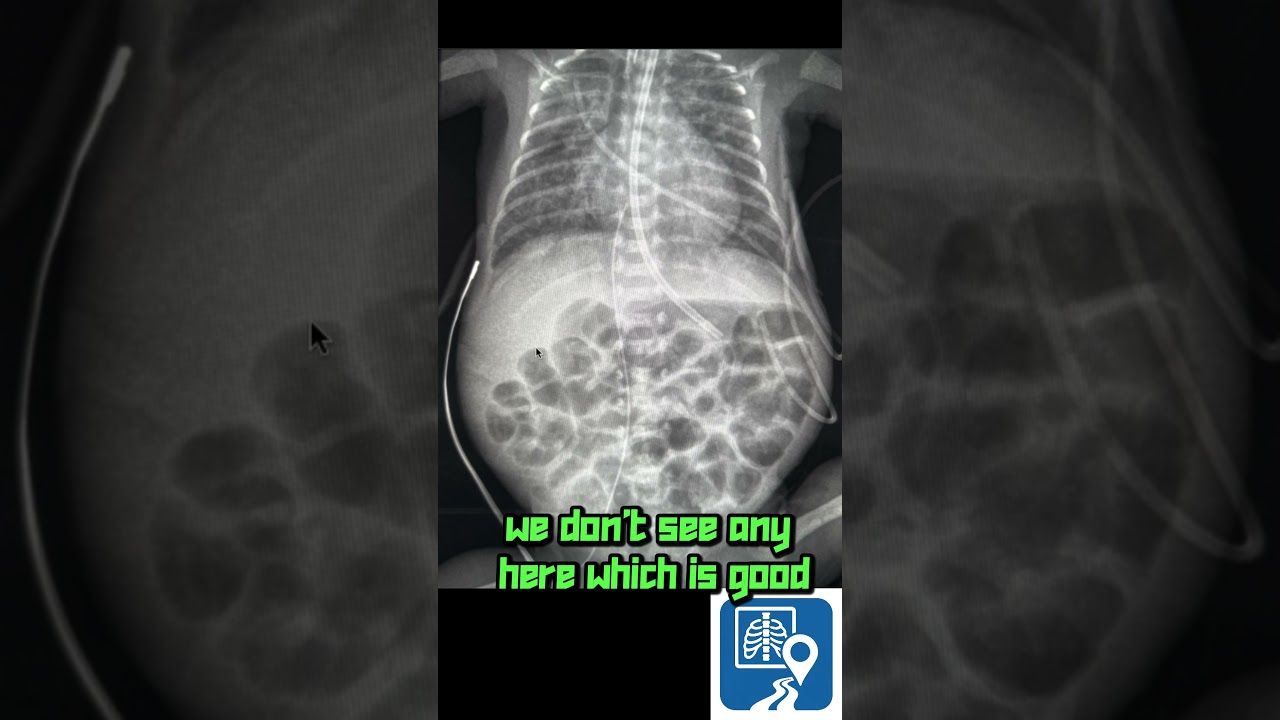 Can You Read This Newborn X-ray? | Pediatric Radiology 