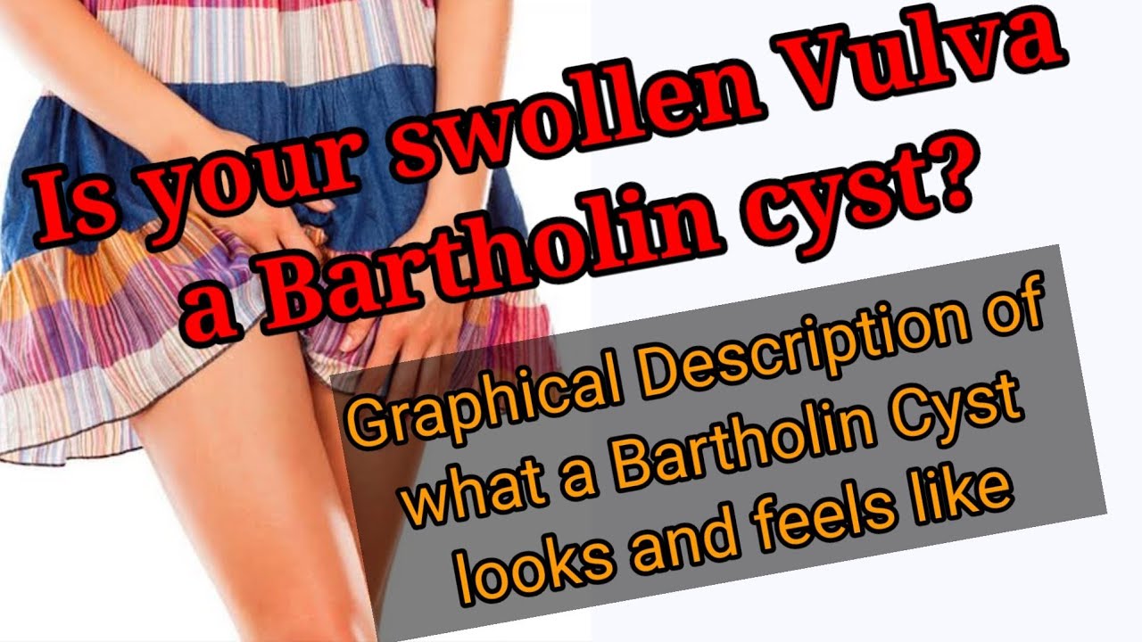 HOW TO IDENTIFY A BARTHOLIN CYST What Is A Bartholin Cyst YouTube how-to-identify-a-bartholin-cyst-what-is-a-bartholin-cyst-youtube