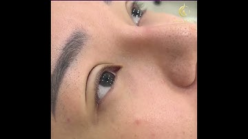 Kết quả ngay sau khi cắt mí Mini Deep [Thạc sĩ - Bác sĩ Lê Quang]