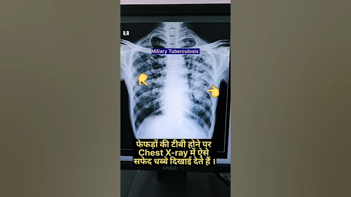 Normal vs TB Chest X-ray #xray #shorts - DayDayNews
