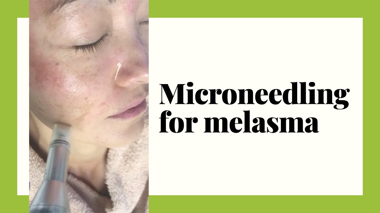 Microneedling for Melasma, Skin pigmentation, Age Spots, Sun Spots YouTube