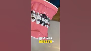Hướng dẫn vệ sinh răng niềng bằng máy tăm nước  #niềngrăng #dentist #orthodontist #niengrang
