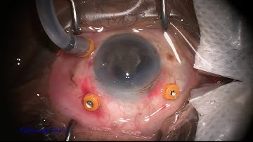 Scaffold IOL technique for dropped nucleus