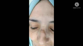 علاج اثار الجروح / ندبات الوجه جراحيا / تحسين اثار جروح الوجه / Scar face
