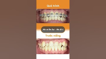 Hành trình LỘT XÁC nhờ niềng răng của Hồng Phương