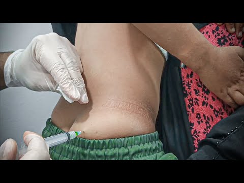 ازاى تدى حقنة عضل لبنك العصبى اللى بيخاف من الحقن