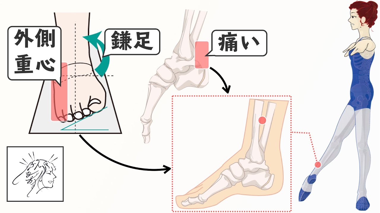 かかとの痛み 鎌足 小指体重にこのツボ 三陰交とバレエ Youtube