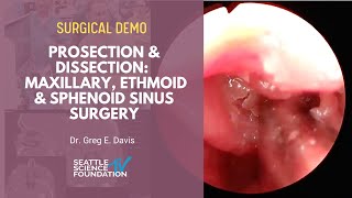 Prosection & Dissection  Maxillary, Ethmoid & Sphenoid Sinus Surgery - Greg E. Davis, M.D.