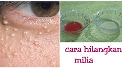 cara alami sangat ampuh menghilangkan Milia - Durasi: 2.28. 
