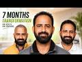 Hair Transplant in Udaipur (HX-JGYQ) | Best Results & Cost of Hair Transplant in Udaipur