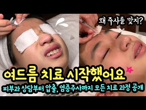 마이린 여드름 치료 시작했어요 (피부과 상담부터 딥클렌징, 압출, 염증주사, 진정관리, 팩까지 치료 과정 모두 공개) 마이린 TV