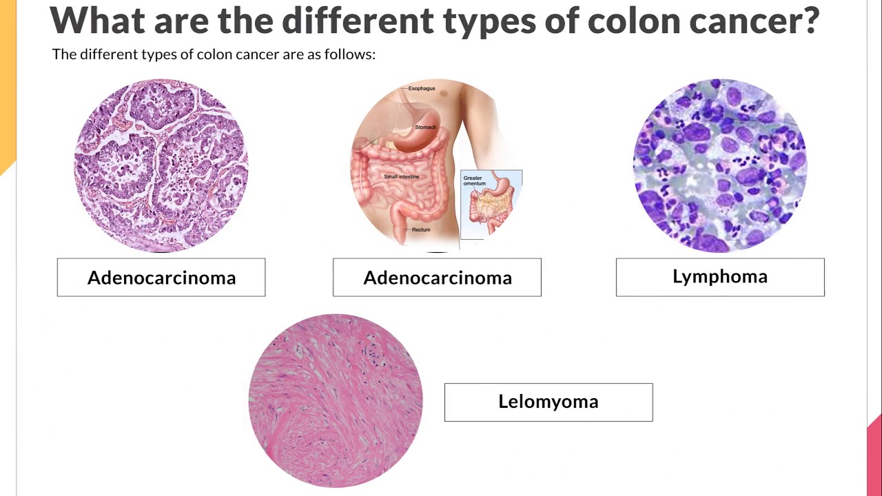 cancer colon types)