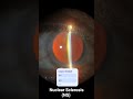 #eyes #opthalmologist #optometry #eyevision #eyehospital