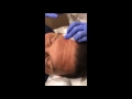 Deep forehead lines removed by belotero filler in nyc