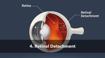 Retinal Detachment