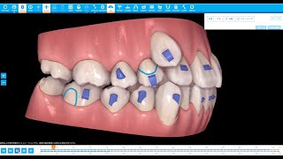 Invisalign Teen High Canine & Anterior Crowding Ext or Non-Extraction?【インビザラインTeen 抜歯か非抜歯？】