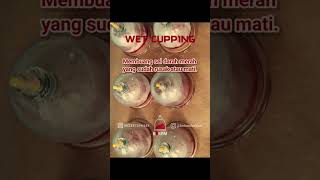 Ready for cupping? ​#CuppingTherapyBali ​#DetoxBali #WetCuppingBali