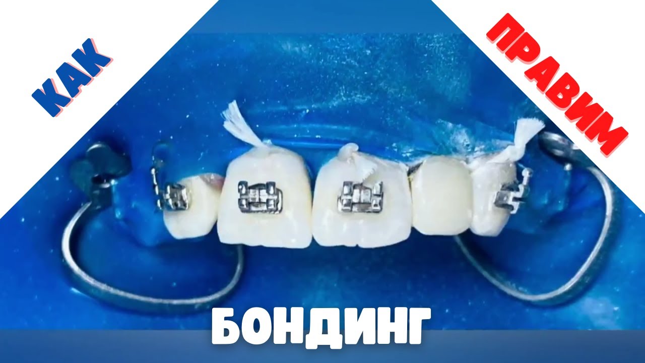 Как се Прави Бондинг на Зъб #бондинг #бондингназъби