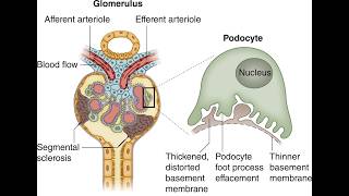 Thin Membrane Disease TMD Or Thin Basement Membrane Nephropathy TBMN or benign familial hematuria