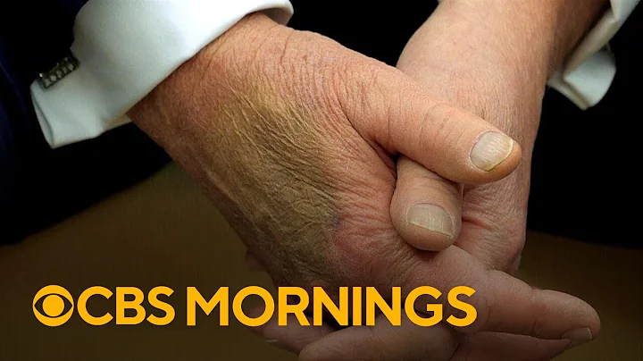 What to know about President Trump's chronic venous insufficiency diagnosis