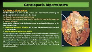 Cardiopatía hipertensiva 2