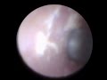 イヤースコープを使って耳掃除Part2(ear cleaning at a scope)