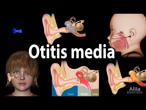 Otitis Media: Anatomy, Pathophysiology, Risk Factors, Types of OM, Symptoms and Treatment, Animation