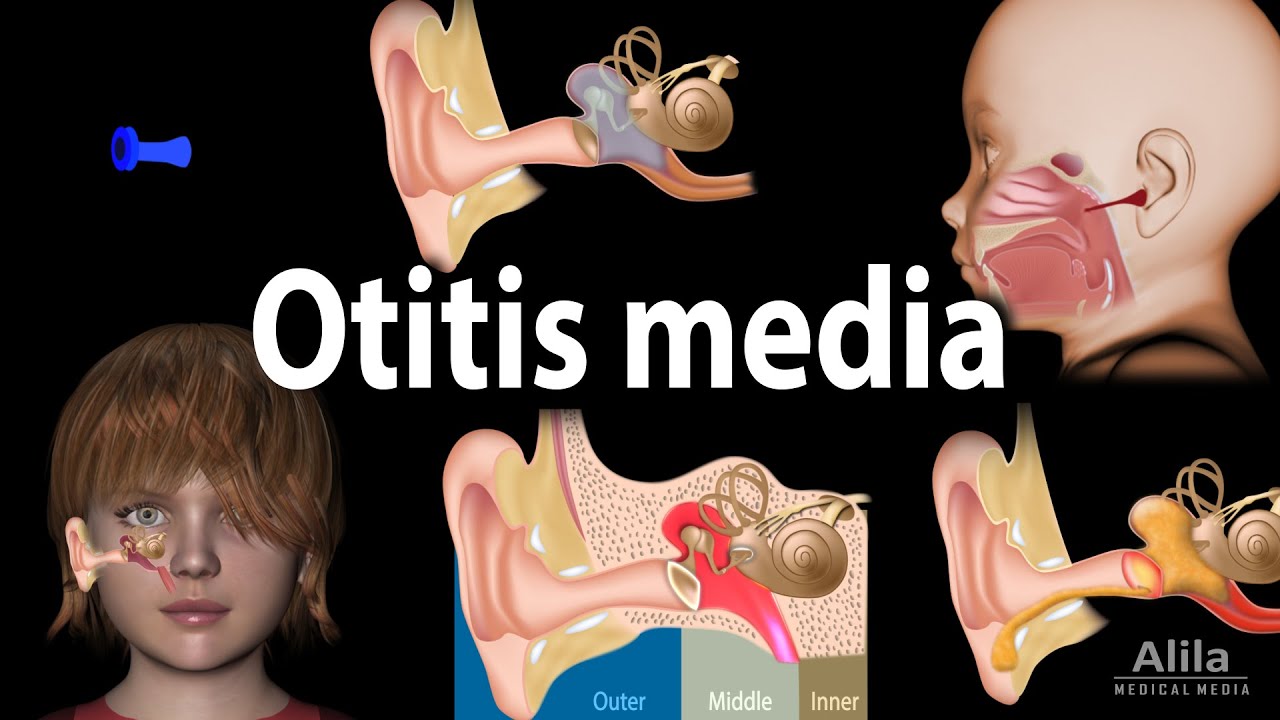 otitis media