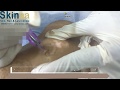 Treatment of white patches or vitiligo or safed daag by micro pigmentation technique in india