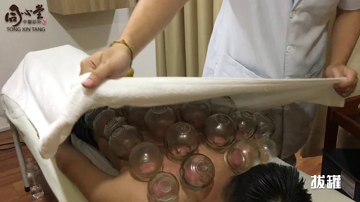 拔罐療法 Cupping Therapy | 同心堂 Tong Xin Tang - 天天要聞