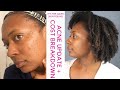 Adult Acne | How I Cleared My Skin Fast - Products + Cost Breakdown | Hormonal Acne, Rosacea