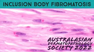 Inclusion Body Fibromatosis (Infantile Digital Fibroma/tosis) in 5 Minutes (dermpath pathology)