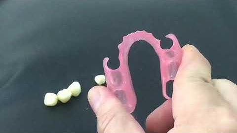 CAD/CAM flexible partial denture