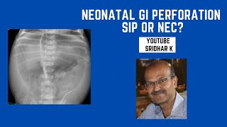 SIP or NEC? Neonatal pneumoperitoneum l gut perforation #SIP #NEC