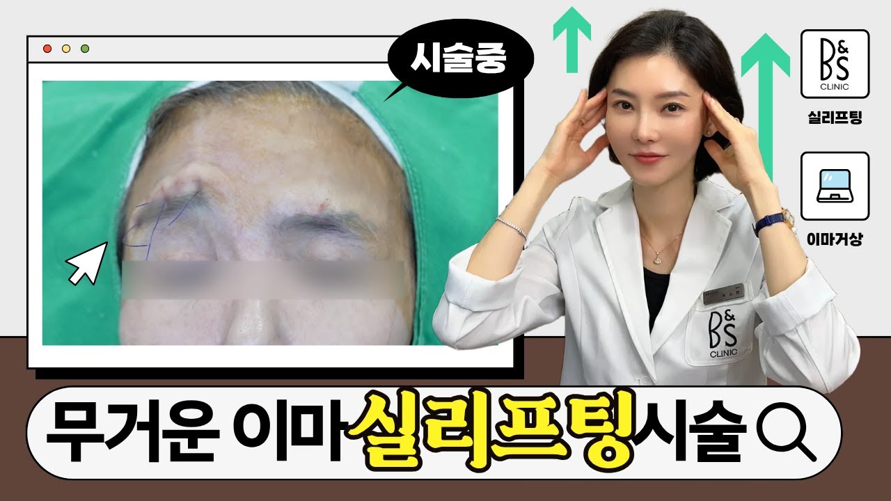 💡무거운 눈, 이마 주름 신경 쓰이시는 분 필수 시청! 이마 거상 실리프팅 리얼 케이스