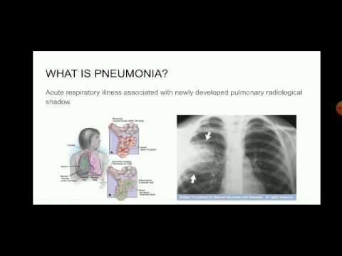 Pneumonia (Almost everything you need to know)