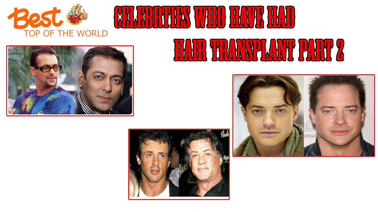 Best Top of The world Celebrities Who Have Had Hair Transplants part 2 - YouTube
