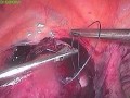 Total laparoscopic hysterectomy for a large uterus