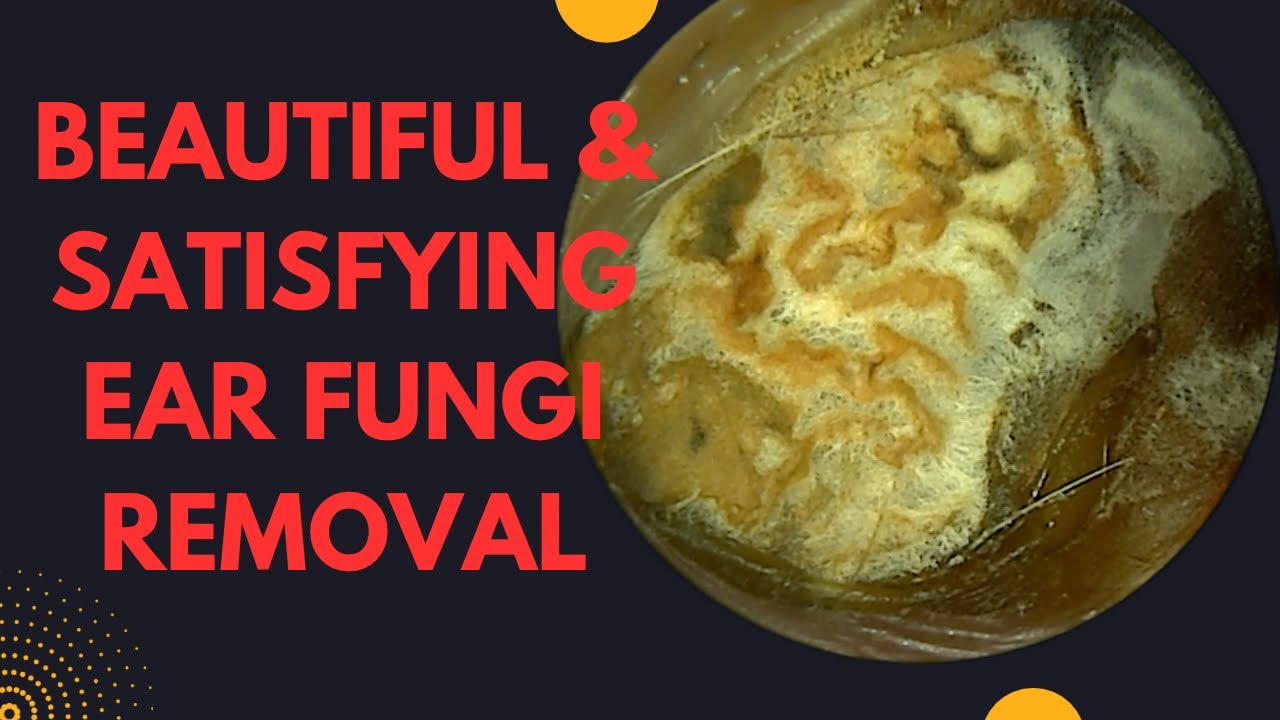 The Most BEAUTIFUL & SATISFYING Ear Fungi Removal Ever!!! The Most BEAUTIFUL & SATISFYING Ear Fungi Removal Ever!!!