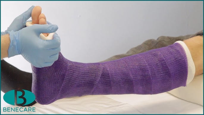 VIDEO: Caring for your cast, Tips to help your limb heal