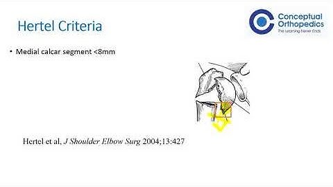 Proximal Humerus Fracture by Our Trauma Specialist Dr.Shailesh Pai @ConceptualOrthopedics